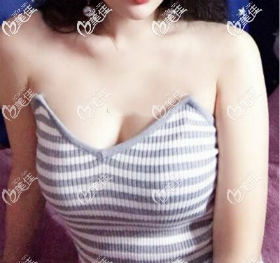 我背著老公偷偷做了自體脂肪隆胸,3個(gè)月吸收自然被發(fā)現(xiàn)后一點(diǎn)都不尷尬