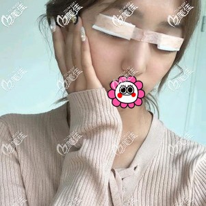 雙眼皮術(shù)后即刻 雙眼皮術(shù)后即刻