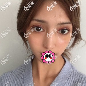 7天拆線后雙眼皮有淤青腫脹 7天拆線后雙眼皮有淤青腫脹