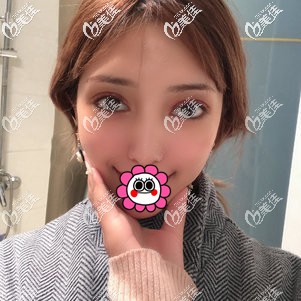 雙眼皮一個(gè)月形態(tài)基本恢復(fù) 雙眼皮一個(gè)月形態(tài)基本恢復(fù)