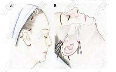 筋膜懸吊手術(shù)的原理 筋膜懸吊手術(shù)的原理