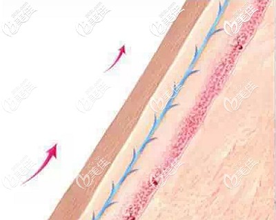 面部埋線提升的優(yōu)勢(shì) 面部埋線提升的優(yōu)勢(shì)