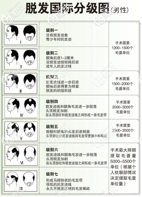 男性脫發(fā)等級(jí)分級(jí)圖示 男性脫發(fā)等級(jí)分級(jí)圖示