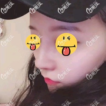 一位做肋骨鼻綜合已經(jīng)維持1年的朋友說恢復過程并沒有別人說的那么痛苦