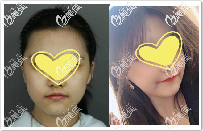 顴骨內(nèi)推+下頜骨截骨手術恢復6個月效果圖