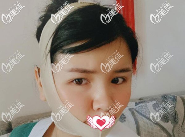 臉部吸脂第二天臉腫的厲害