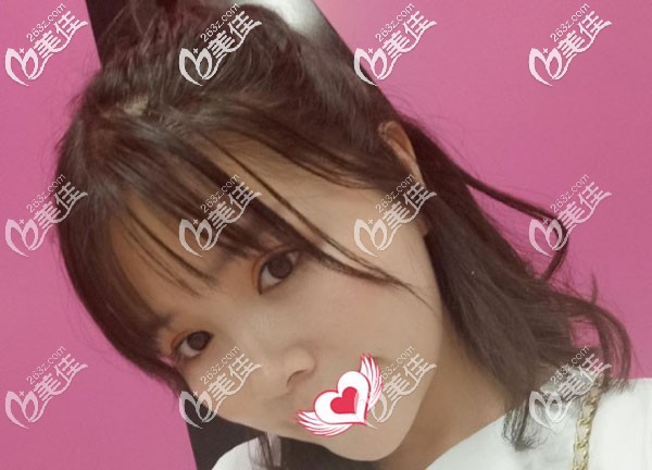 面部吸脂一個月輪廓已經(jīng)顯示出來了