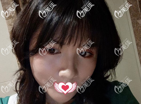 面部吸脂術后40天臉頰的脂肪已經(jīng)掉下來了