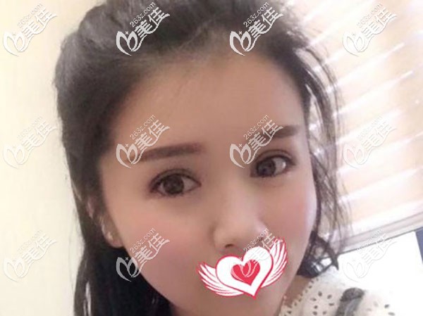 我面部吸脂第二天好嚇人，沒想到2個(gè)月后的效果對(duì)比照驚到遠(yuǎn)方的他