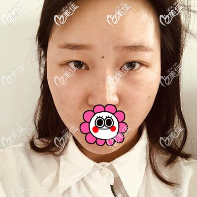 做完手術(shù)一個(gè)星期照片 做完手術(shù)一個(gè)星期照片