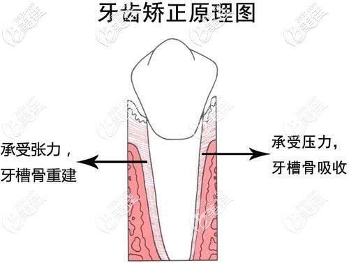 牙齒矯正的原理
