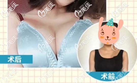 蘭州夢想整形醫(yī)院自體脂肪豐胸<span style= 蘭州夢想整形醫(yī)院自體脂肪豐胸<span style=