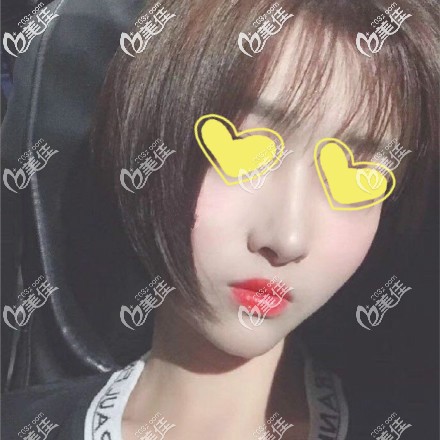 做美國舒鉑鼻恢復(fù)三個月效果圖片