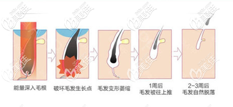 翠綠寶石激光脫毛示意圖