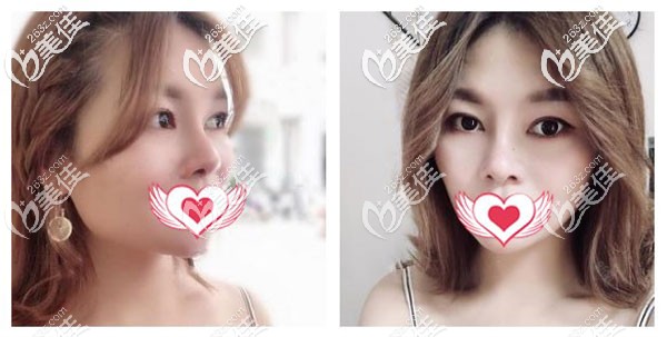 硅膠鼻2個月的恢復(fù)效果圖