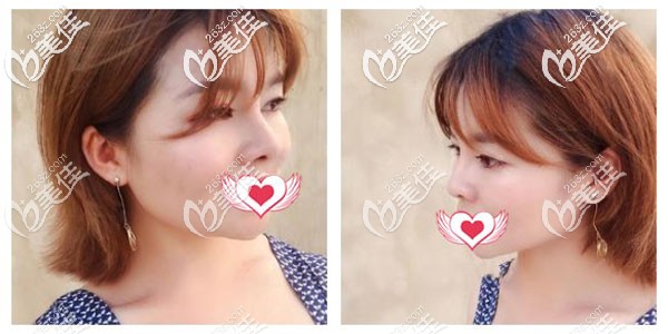 硅膠假體隆鼻20天鼻子還麻，并不代表三個(gè)月后會(huì)摸到假體出現(xiàn)透光等現(xiàn)象