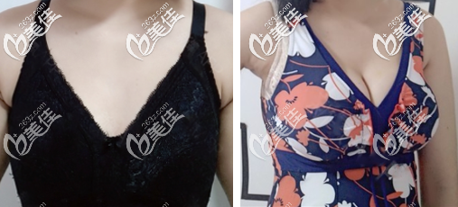 北京艾瑪韋元強(qiáng)醫(yī)生自體脂肪豐胸案例 北京艾瑪韋元強(qiáng)醫(yī)生自體脂肪豐胸案例