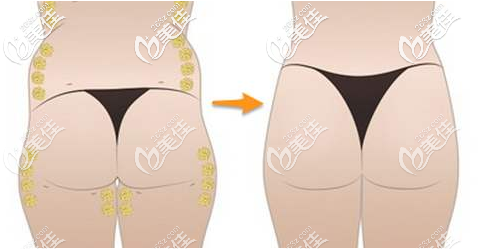 北京潤美玉之光自體脂肪豐臀價格 北京潤美玉之光自體脂肪豐臀價格