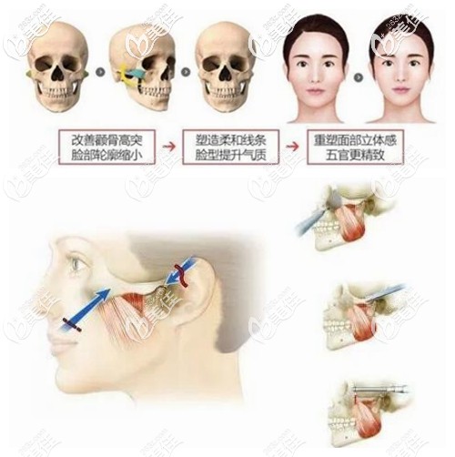 顴弓內(nèi)推手術(shù)原理示意圖