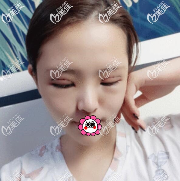 雙眼皮術(shù)后三天恢復(fù)效果