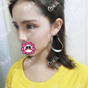 術(shù)后7天拆線后恢復(fù)的效果