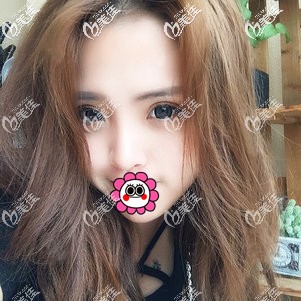 打聽瑞安割雙眼皮的價格參差不齊后，在瑞安瑞麗花了不到萬元的雙眼皮效果你們覺著咋樣