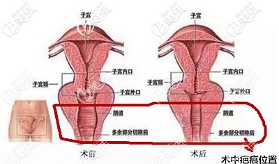 陰道緊縮手術(shù)的原理 陰道緊縮手術(shù)的原理