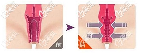 找南陽(yáng)正規(guī)整形醫(yī)院做私密整形后的感想：做縮陰手術(shù)后老公更粘我了