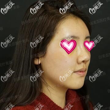 鼻綜合術(shù)后第8天拆線 鼻綜合術(shù)后第8天拆線