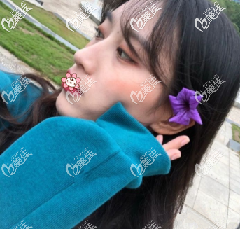 重慶軍科林勇假體隆鼻術(shù)后40天 重慶軍科林勇假體隆鼻術(shù)后40天