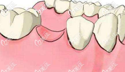門牙缺失怎么修復(fù) 門牙缺失怎么修復(fù)