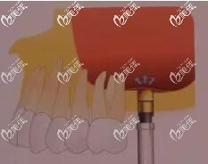 上頜竇內(nèi)提升