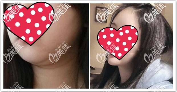 下頜緣抽脂前后對比圖 下頜緣抽脂前后對比圖