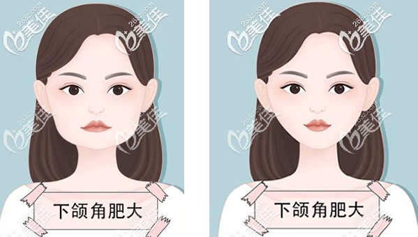 下頜角截骨前后效果對(duì)比