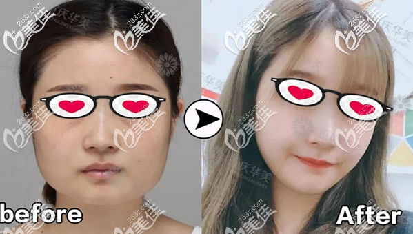 削骨三年后的真實(shí)案例