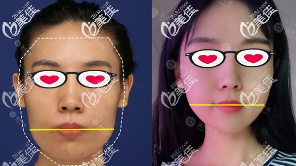 方臉女生顴骨和下頜角一起做的效果