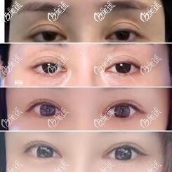 大樓愛得麗格劉志剛雙眼皮修復(fù)眼睛效果和價格 大樓愛得麗格劉志剛雙眼皮修復(fù)眼睛效果和價格