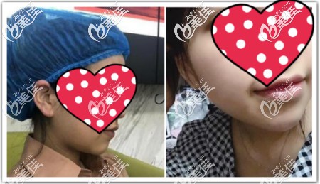 下頜緣提升真人案例效果對比圖