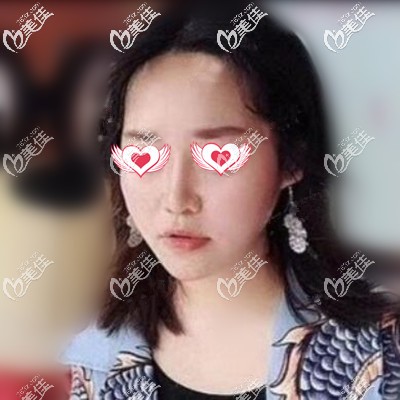 做鼻綜合一周拆線