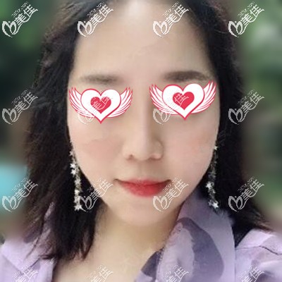 做完鼻綜合術后半個月的恢復效果照