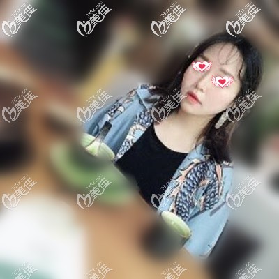 鼻綜合術后1個月時的恢復效果照片