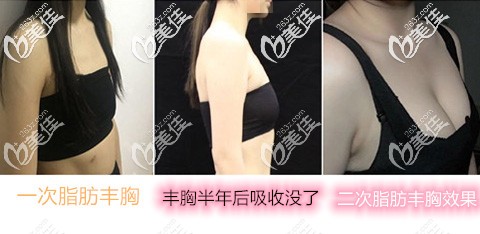 自體脂肪隆胸全部吸收沒了