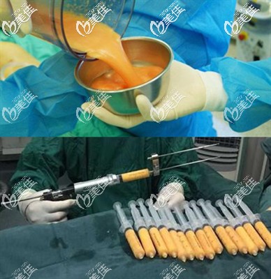 自體脂肪隆胸如何提高成活率