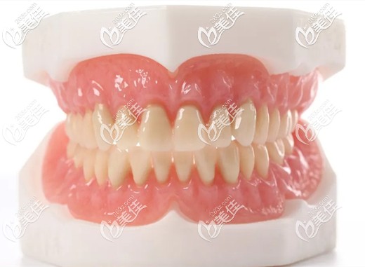 吸附性義齒示意圖 吸附性義齒示意圖