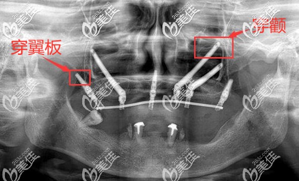 什么是穿顴穿翼板種植牙技術 什么是穿顴穿翼板種植牙技術
