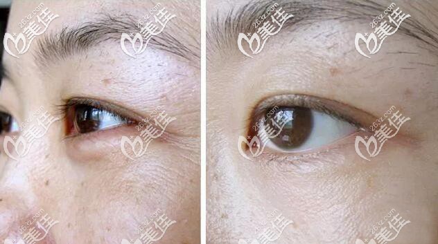 熱瑪吉治療效果