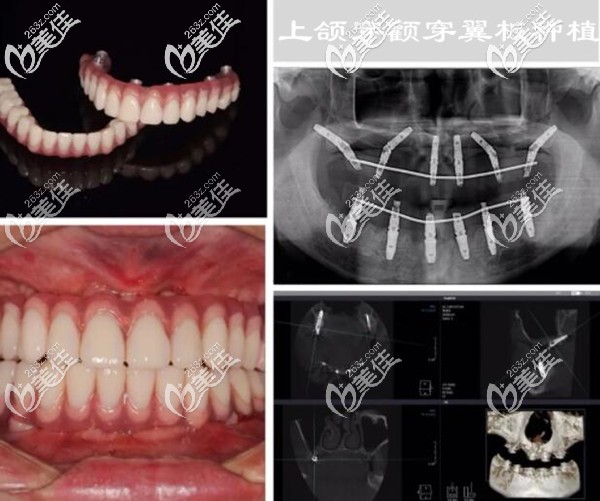上頜牙槽骨不足做穿顴穿翼板種植牙案例 上頜牙槽骨不足做穿顴穿翼板種植牙案例
