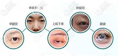 普瀟院長(zhǎng)在做雙眼皮方面的技術(shù)優(yōu)勢(shì)