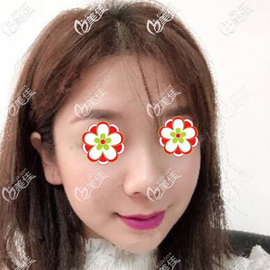 注射玻尿酸瘦臉術(shù)后3天照