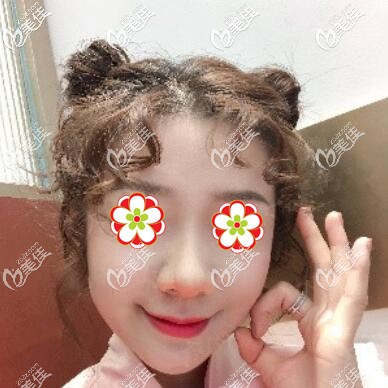 注射玻尿酸+瘦臉術(shù)后半個月效果照